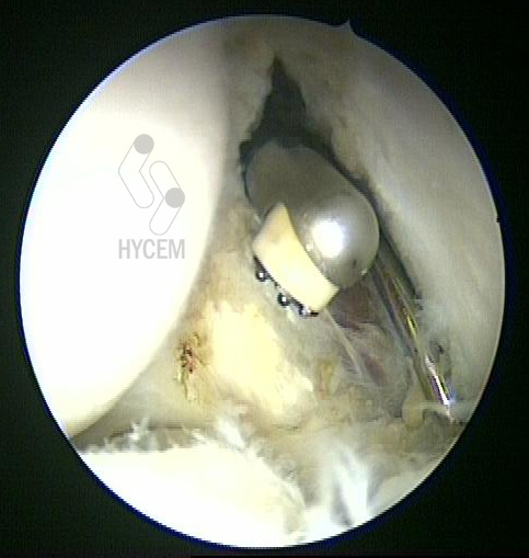 Imagen artroscópica del tratamiento quirúrgico de la epicondilitis lateral