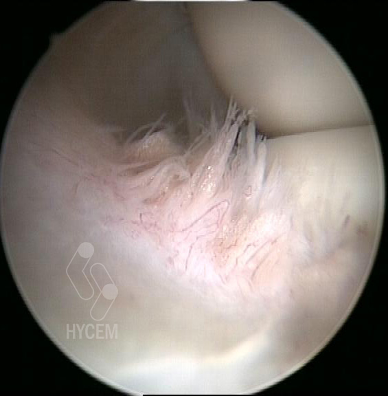 Imagen artroscópica de la articulación del codo con sinovitis alrededor de la cabeza del radio