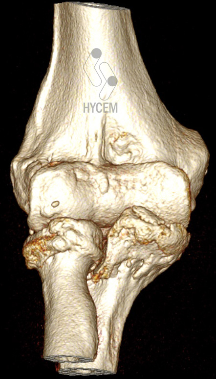 Imagen tridimensional de una artrosis de codo