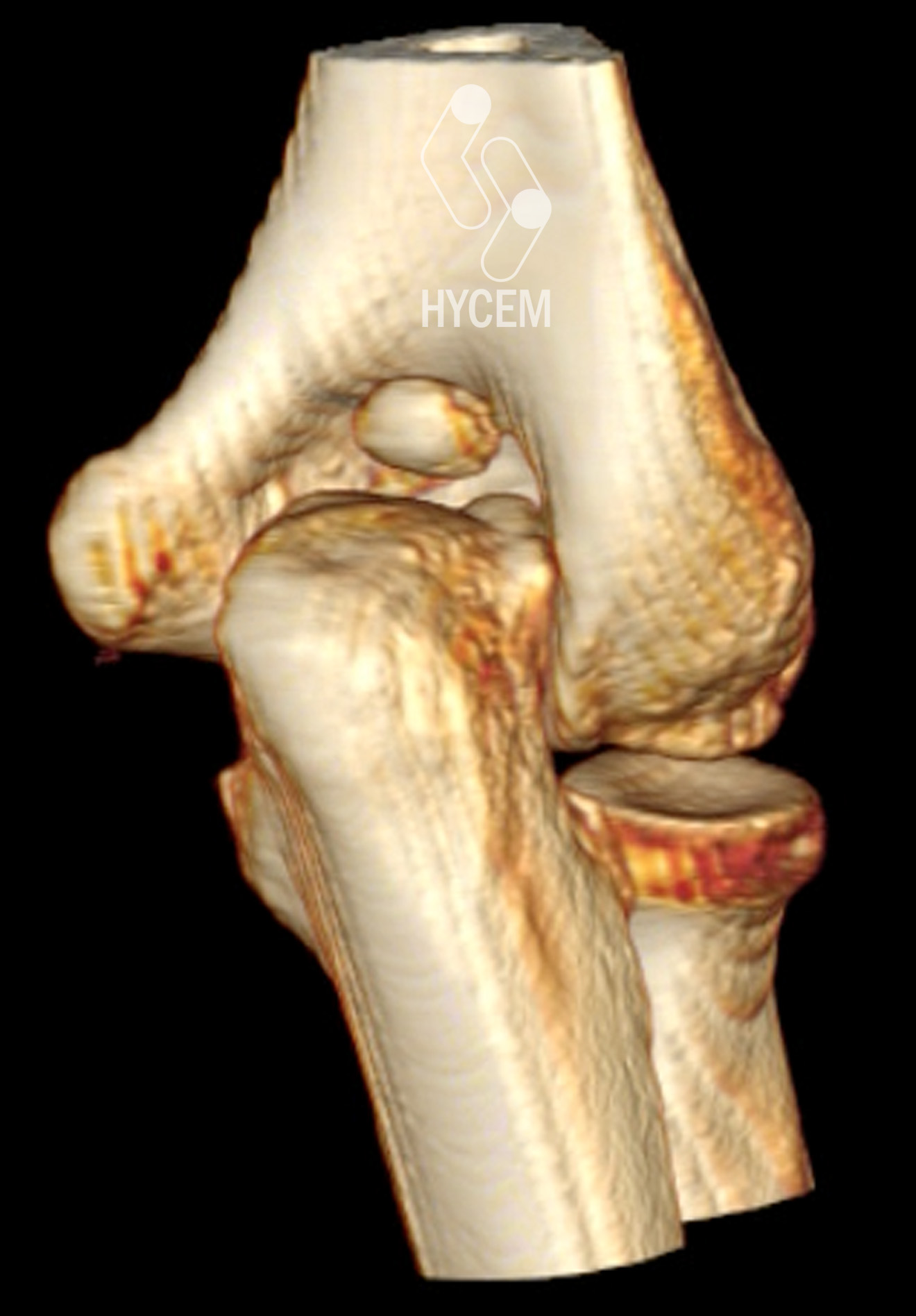 Artritis reumatoide con severa destrucción articular del codo		