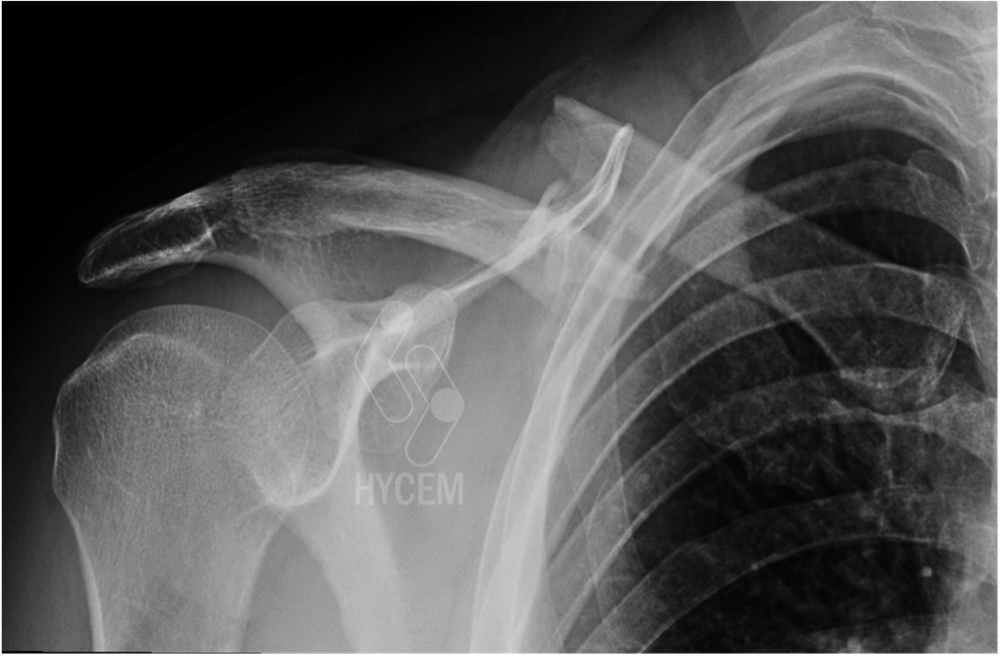 Imagen 1. RX fractura clavícula