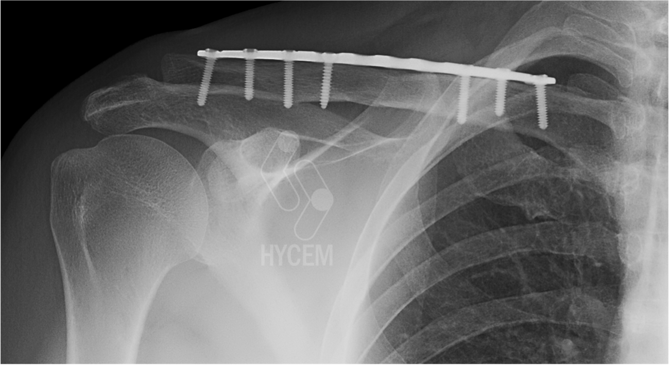 Imagen 2. RX síntesis fractura clavícula con placa
