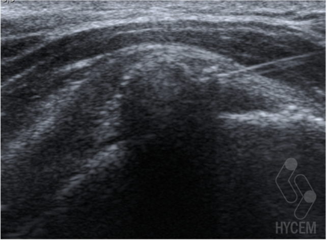 Imagen 5. Imagen ecográfica de una punción ecoguiada de tendinitis calcificante de supraespinoso