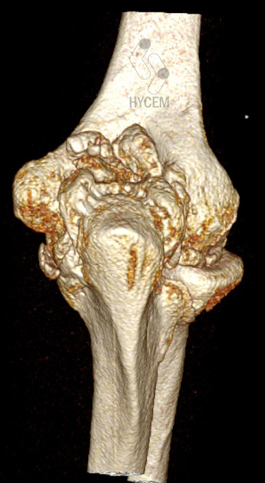 Osteofitos posteriores de codo TAC 3D