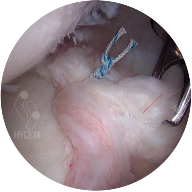 Visión artroscópica de reparación labral