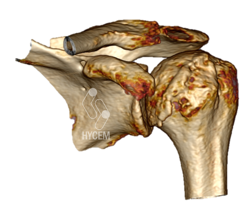 TC 3D de artrosis de hombro